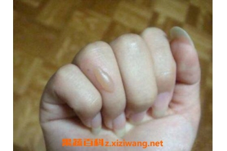 被油烫伤怎么办 被油溅到了皮肤小妙招