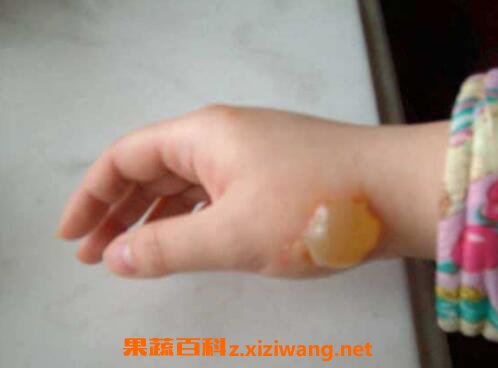 被油烫伤后怎么处理 油烫伤后的处理方法