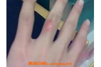 油烫伤起泡后怎么处理 被油烫伤怎么去疤